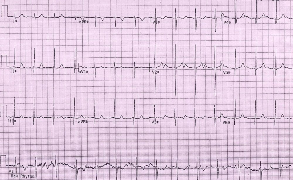 Peak exercise tracing in congenital complete heart block