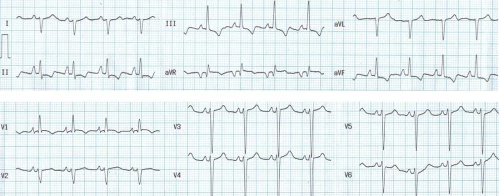 Right ventricular hypertrophy