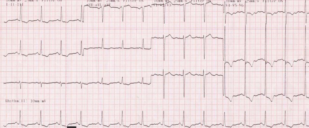 Severe left ventricular hypertrophy with strain pattern in severe aortic stenosis