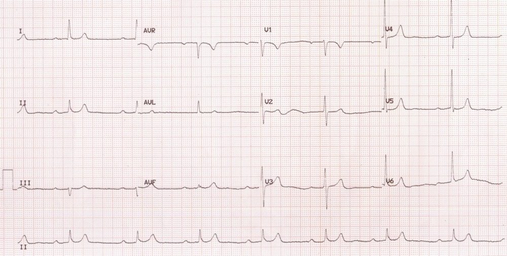 Sinus bradycardia with first degree AV block