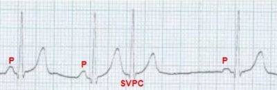 Supraventricular ectopic beat (SVPC)
