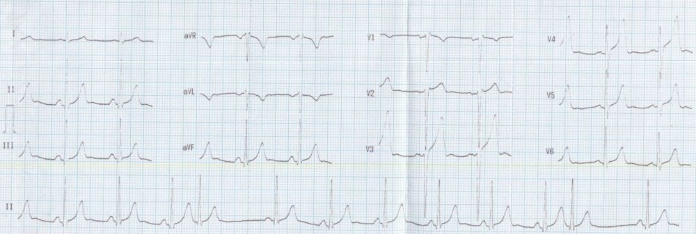 Supraventricular ectopics