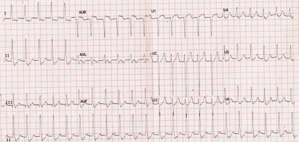 supraventricular-tachycardia-ecg