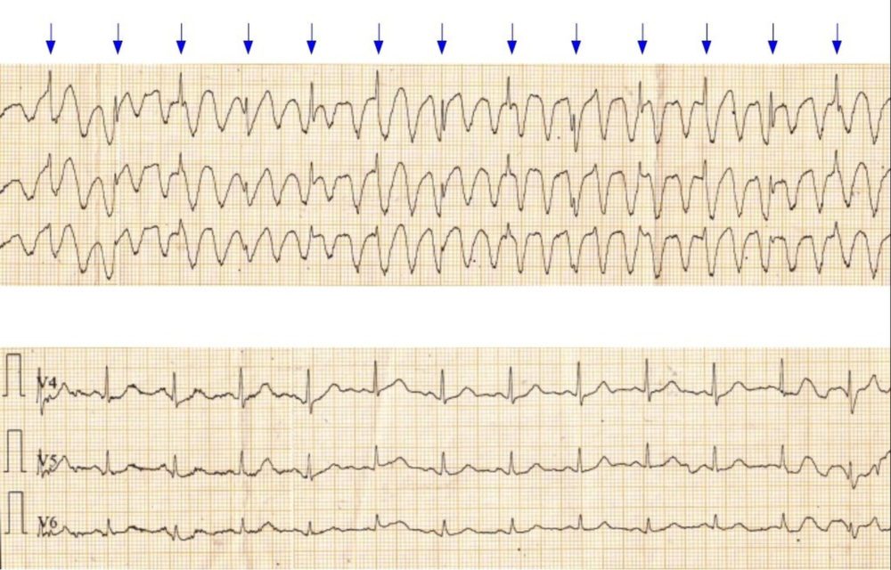 Tremor artefact resembling ventricular tachycardia