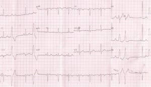 Ventricular Arrhythmia - All About Cardiovascular System and Disorders