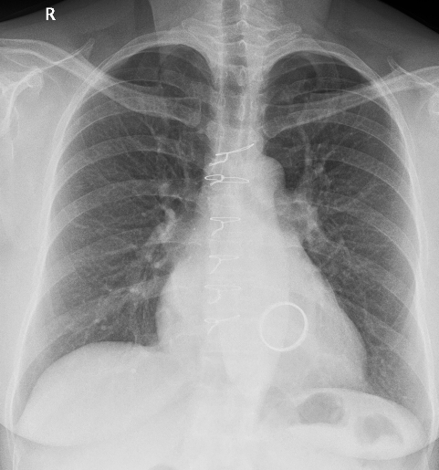 Tilting disc mitral prosthetic valve on X-ray chest PA view