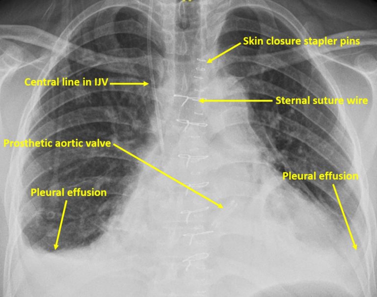 X-ray Quiz 9 – All About Cardiovascular System and Disorders