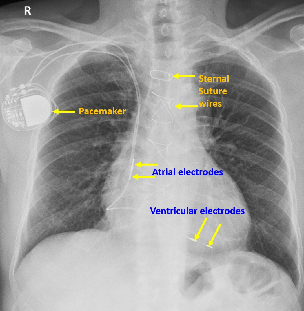 Dual chamber pacemaker with leads