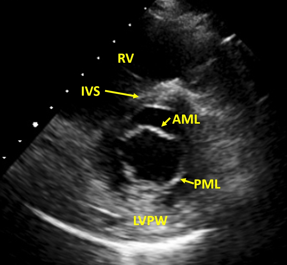 Normal mitral valve cross section for comparison