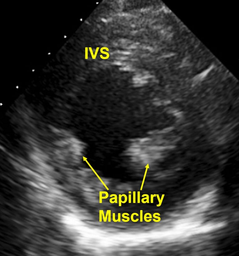 Papillary muscles - echocardiogram