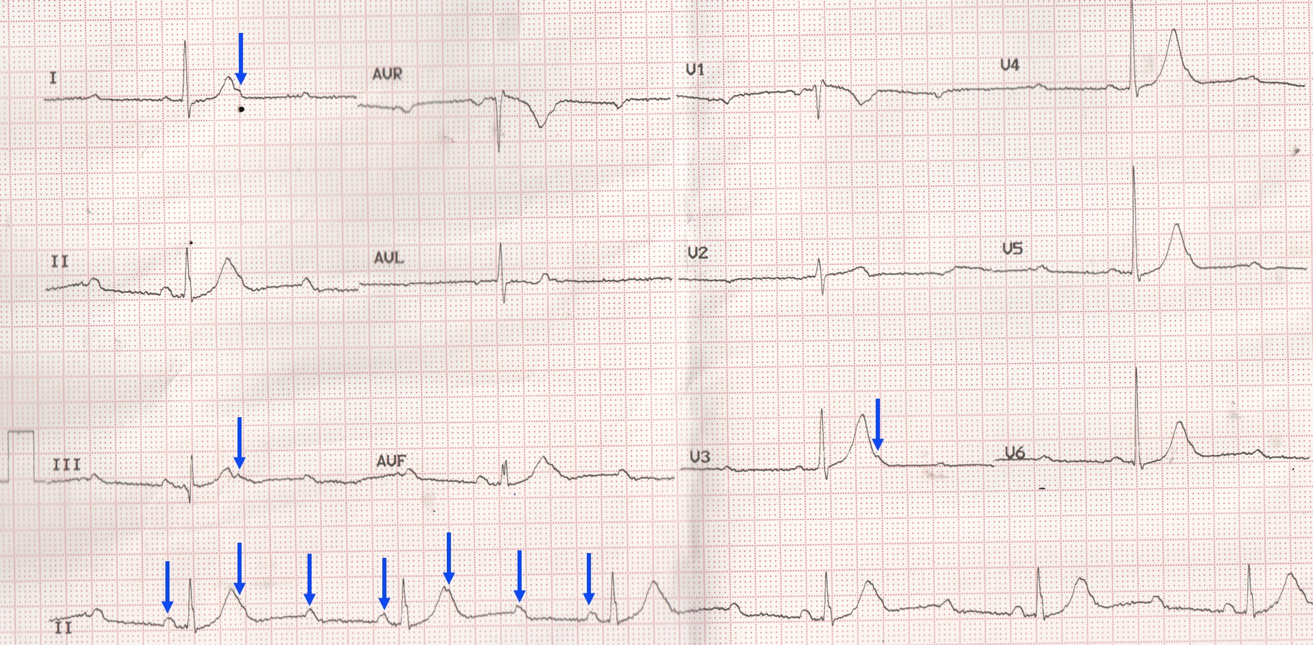 ecg-quiz-55-discussion-3-1-av-block-all-about-cardiovascular