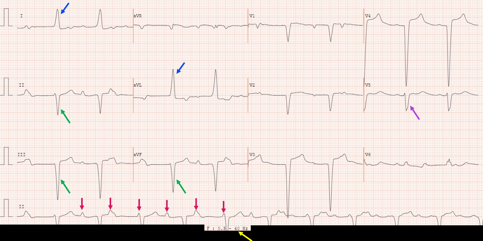 What Paced Rhythm Looks Like on Your Watch ECG