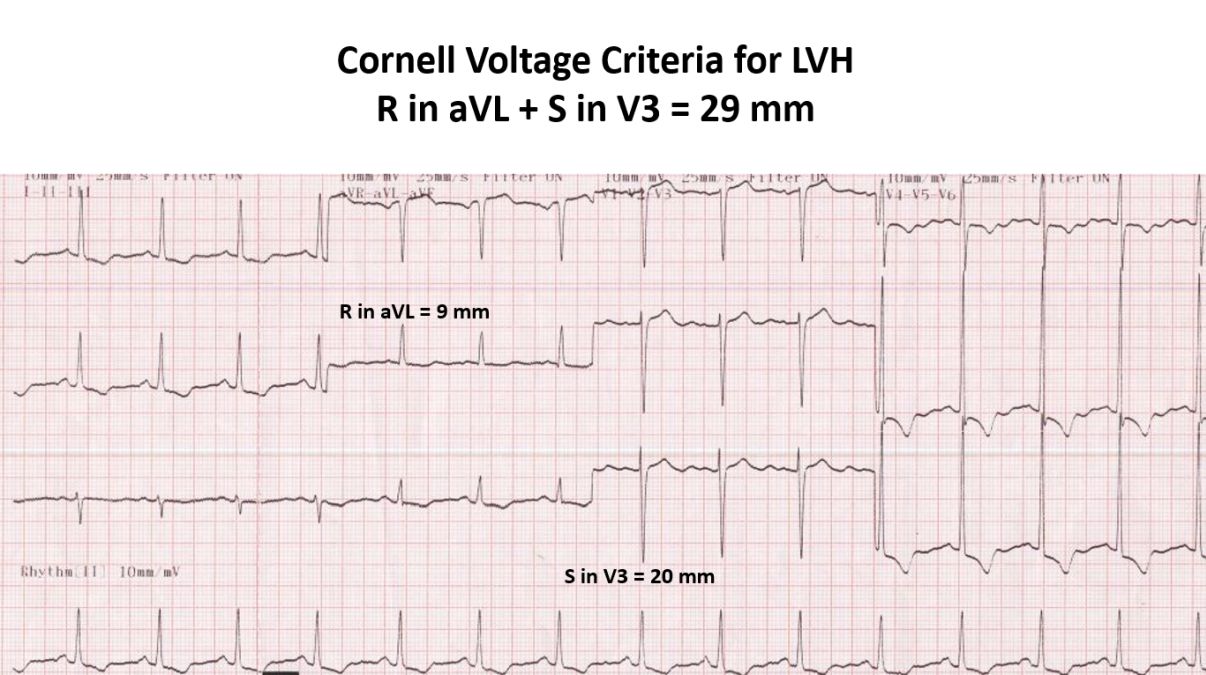 ECG showing Cornell Voltage Criteria for LVH
