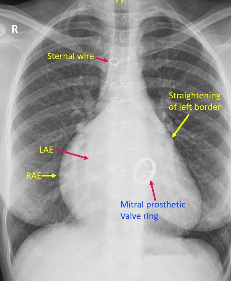 X-ray Quiz 10 – Discussion – All About Cardiovascular System and Disorders