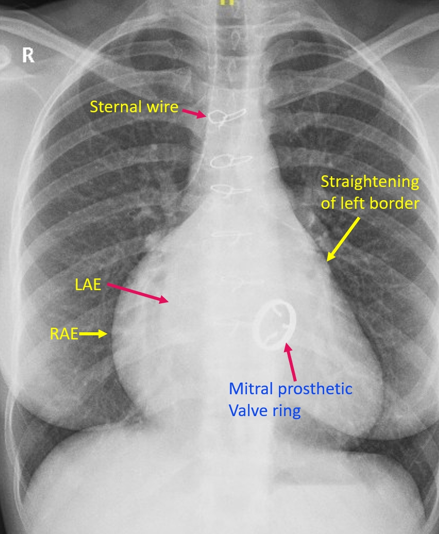 Mitral Valve Replacement X Ray All In One Photos