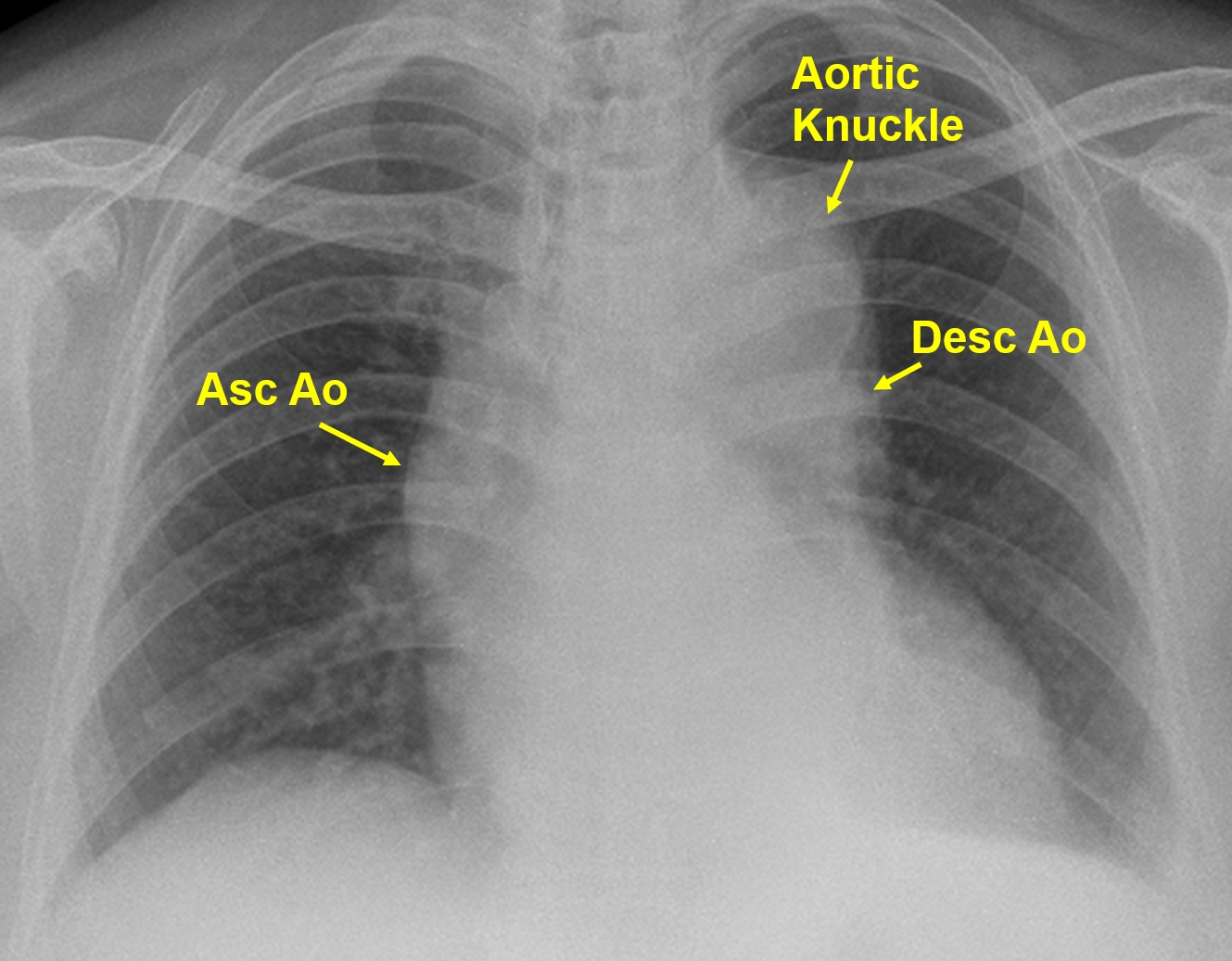Aortic Aneurysm Chest X Ray