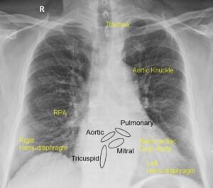 Prosthetic heart valves on CXR – All About Cardiovascular System and ...