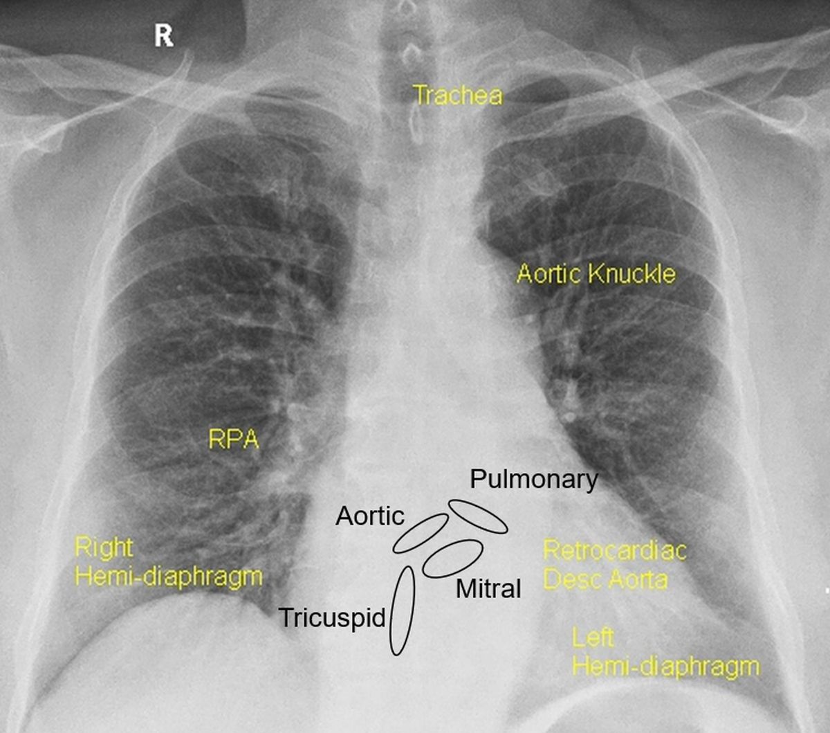 Approximate positions of cardiac valves on CXR