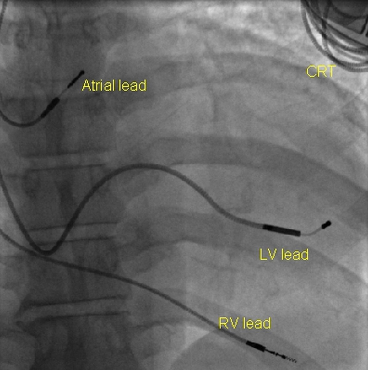 Fluoroscopic view of three leads of a CRT