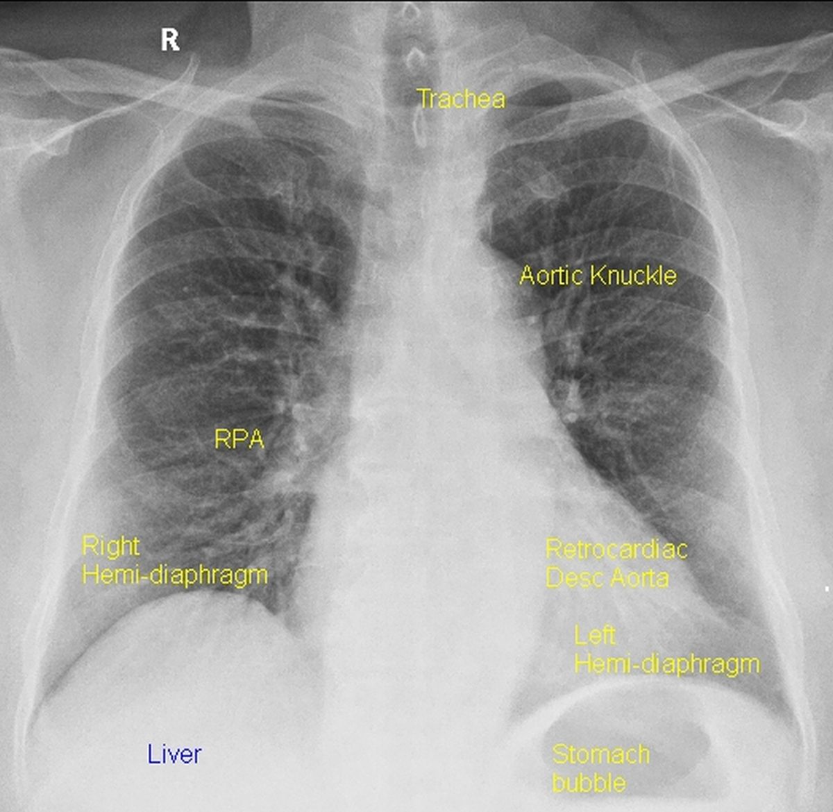 X-ray chest (CXR) PA view