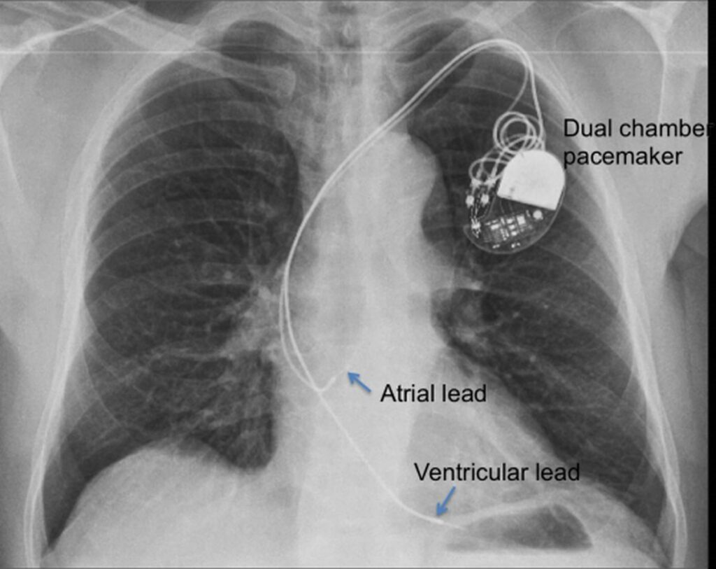 Cardiac implantable electronic devices (CIED) on CXR