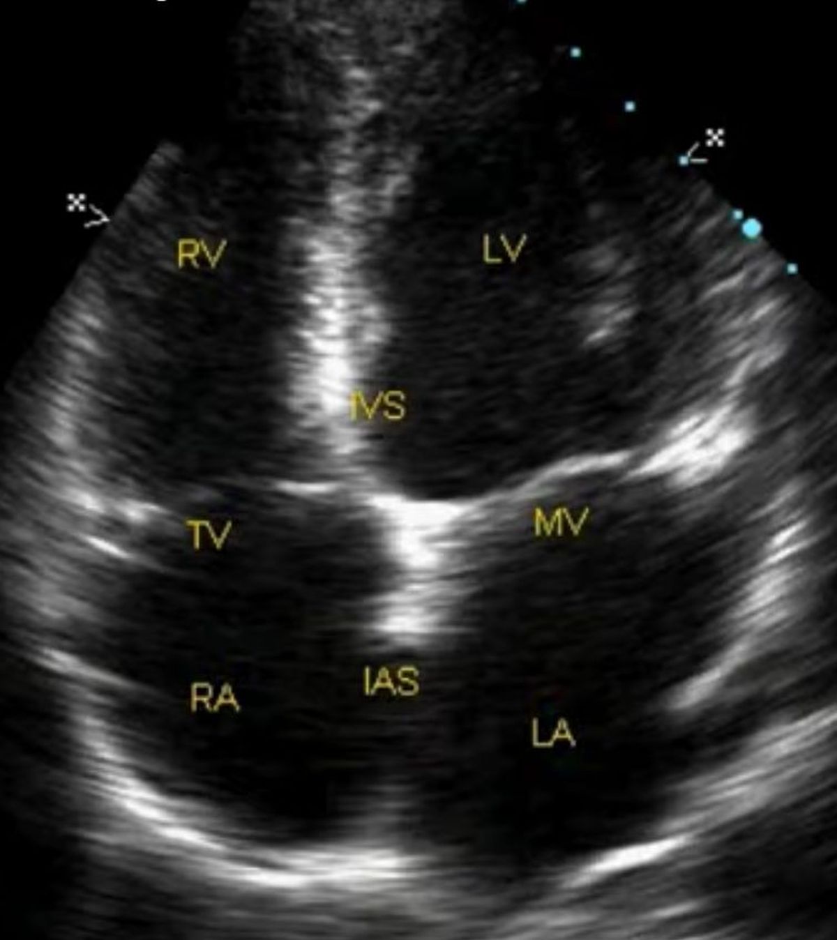 Echocardiogram (ultrasound image of the heart) showing four chambers and two valves