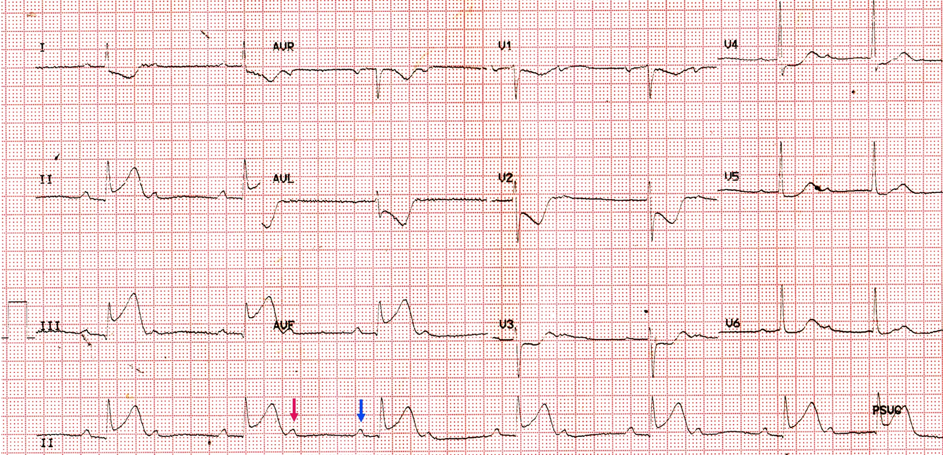 ECG in hyperacute phase of inferior wall myocardial infarction with 2:1 AV block