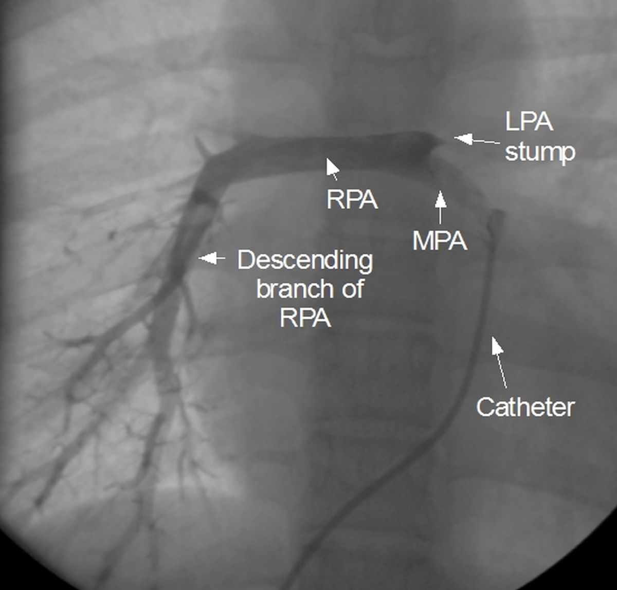 Pulmonary angiogram showing hypoplastic main pulmonary artery and right pulmonary artery