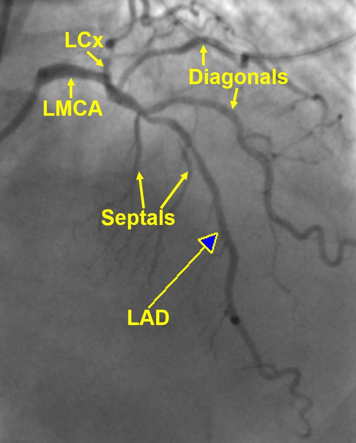 Left coronary angiogram showing its branches