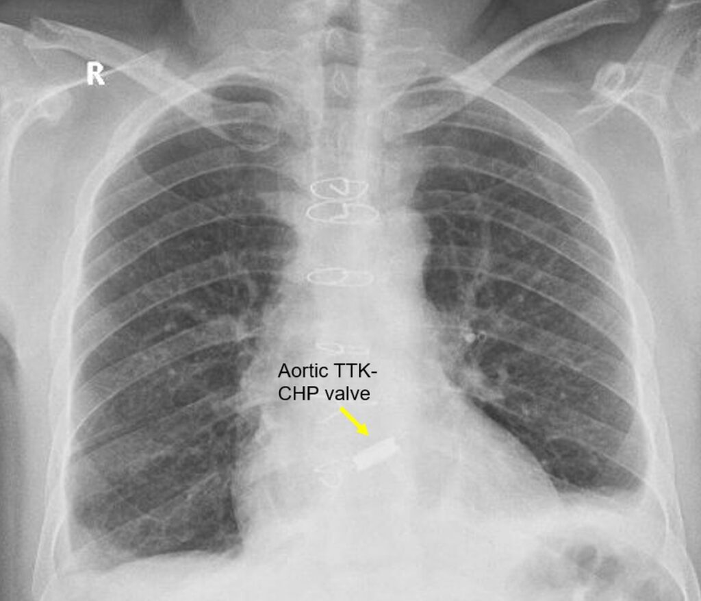 Prosthetic Heart Valves On Cxr All About Cardiovascul - vrogue.co