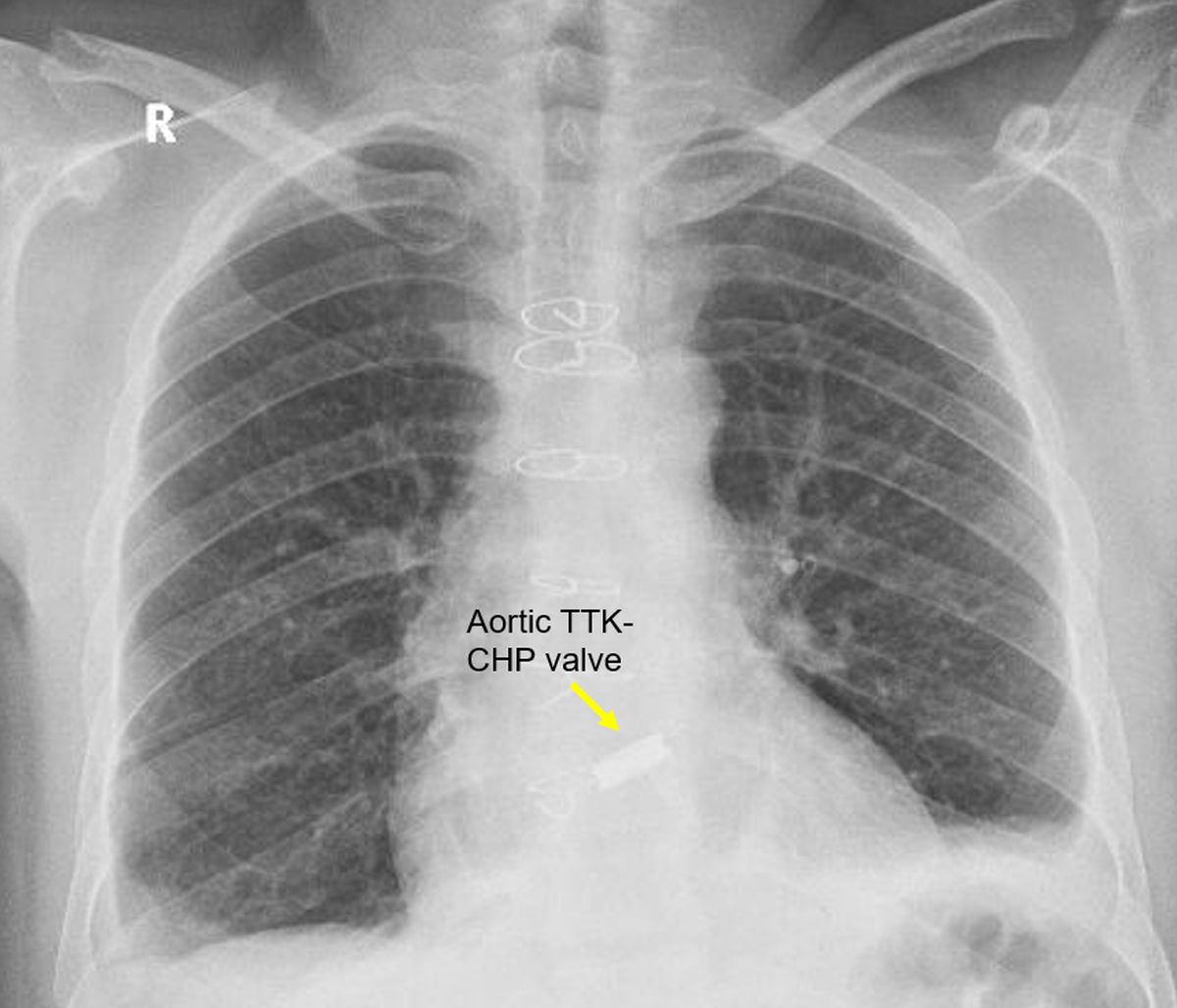 Prosthetic TTK Chitra aortic valve on chest X-ray