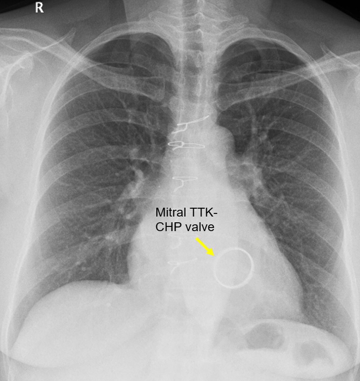 Prosthetic TTK Chitra mitral valve on chest X-ray