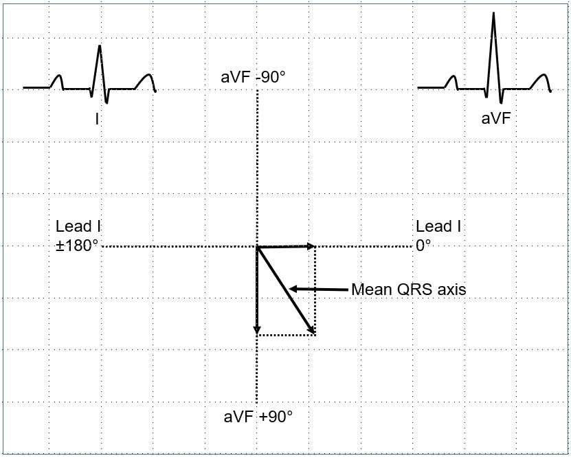 Determination QRS axis using leads I and aVF