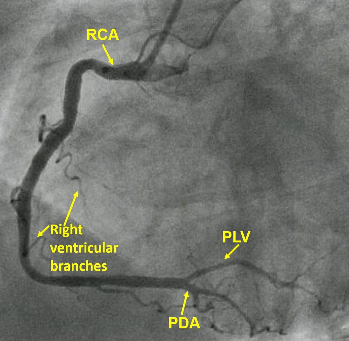 Right  coronary angiogram showing its branches