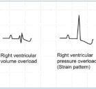 Friedewald equation for calculation of LDL cholesterol and VLDL