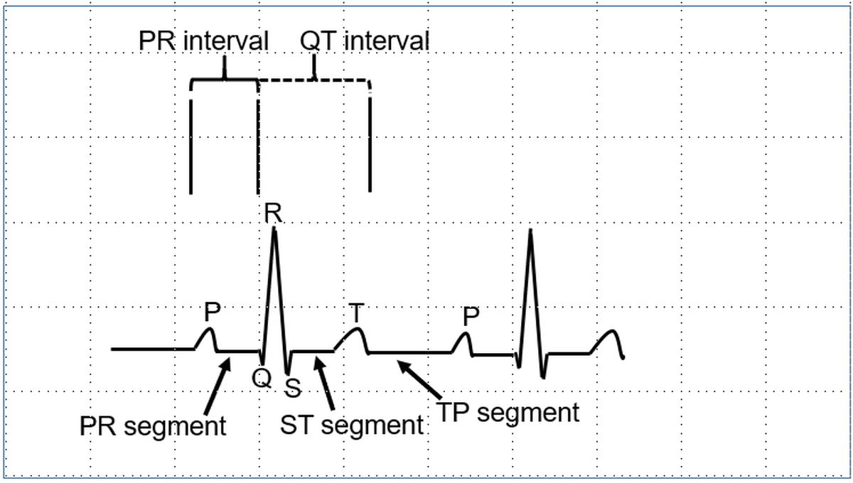 Segments and intervals in an ECG