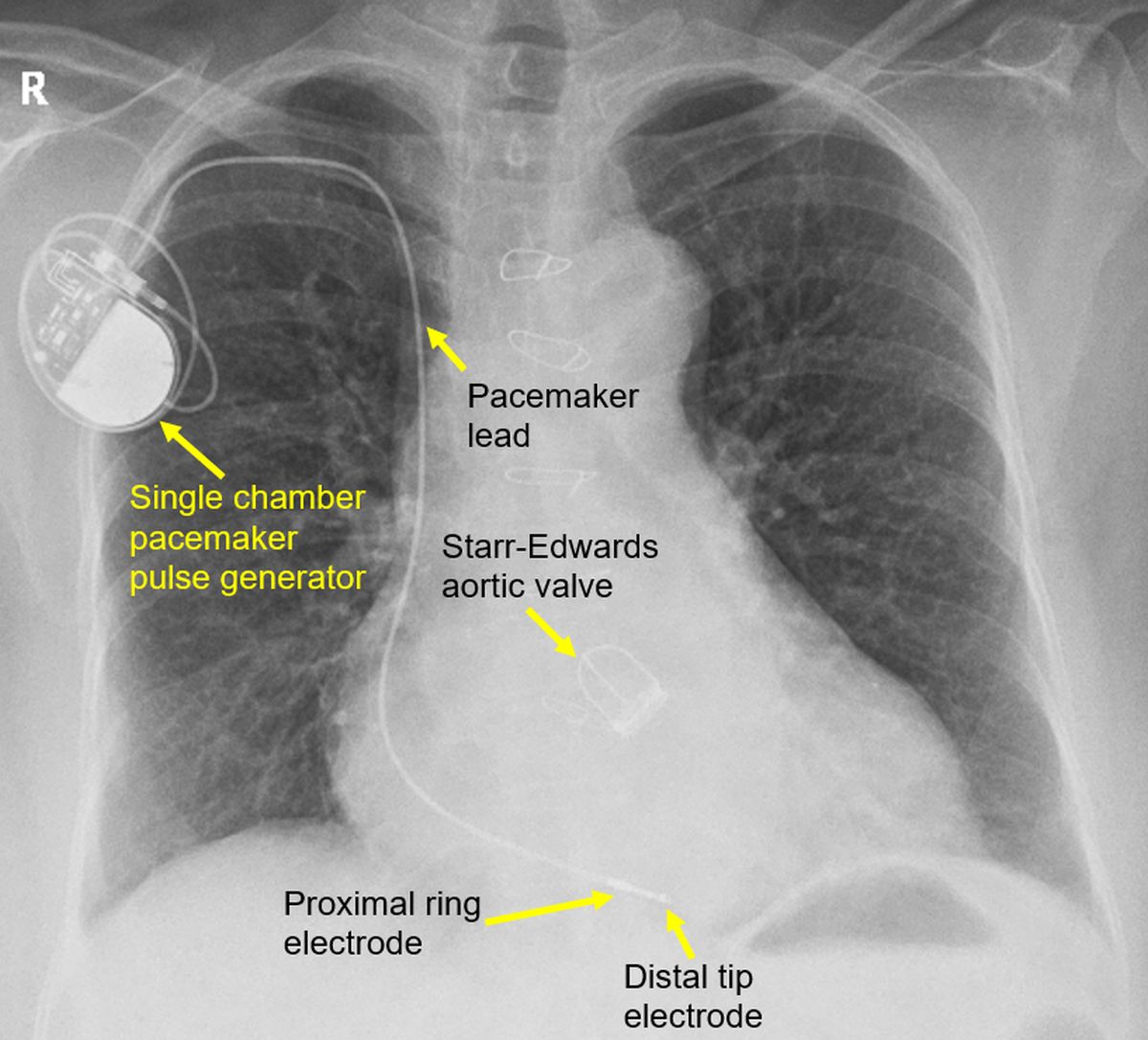 Single chamber pacemaker and aortic prosthetic valve (SEP).