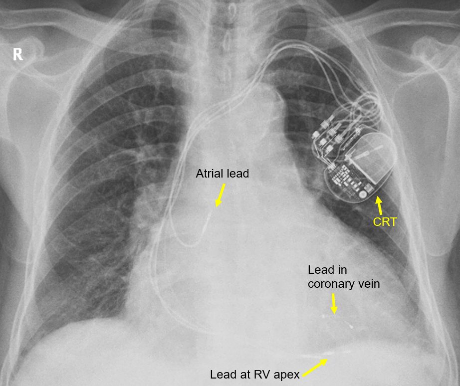 X-ray Chest in CRT-P showing pulse generator and three leads.