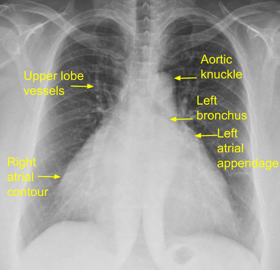 Prominent upper lobe vessels (antler sign), left atrial appendage (third mogul sign) and right atrial enlargement.