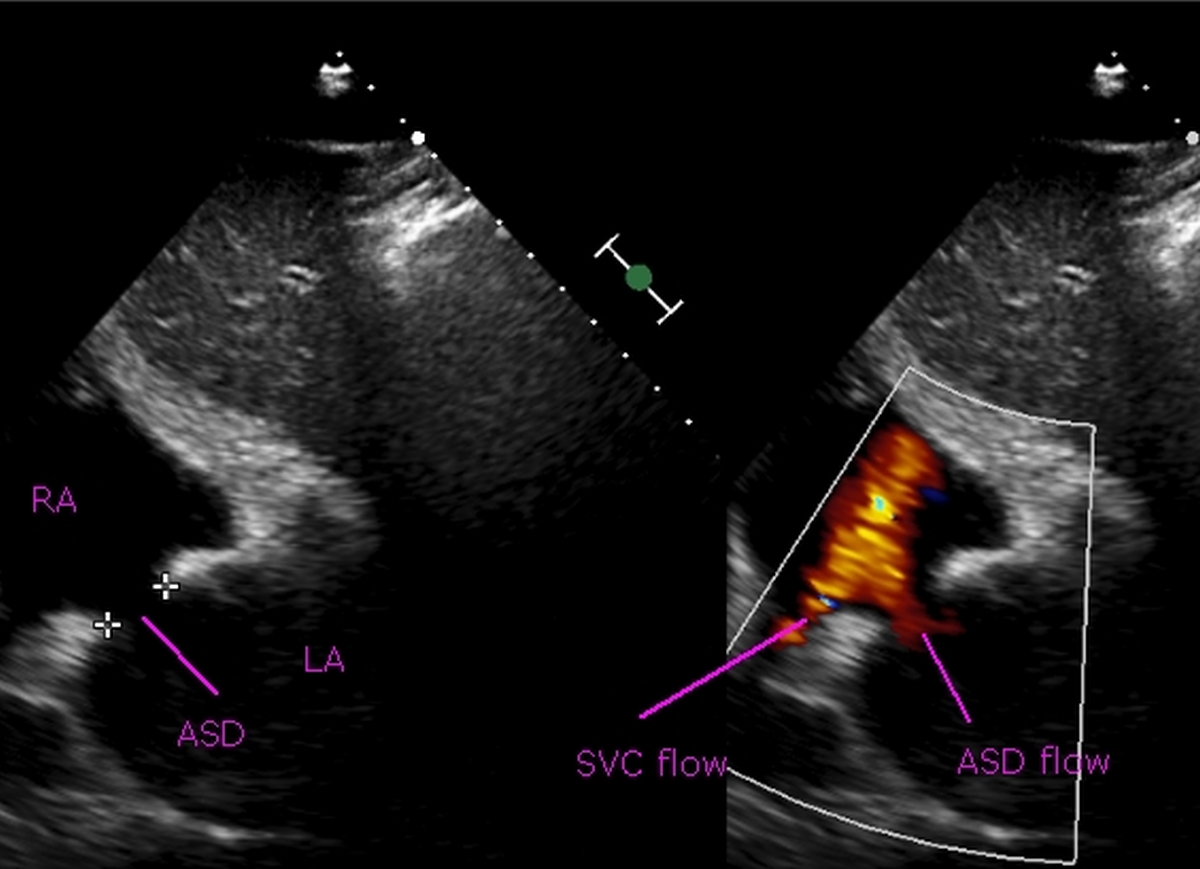 Subcostal view showing a 15 mm ASD on color Doppler echocardiogram