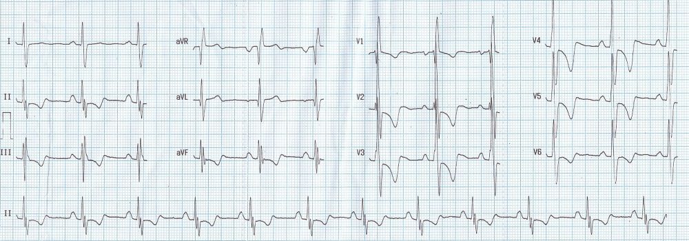 Atrial Septal Defect Ecg