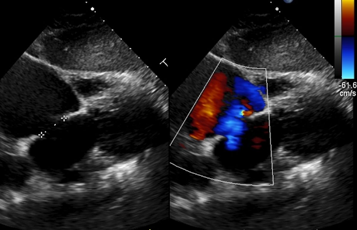 ASD with right to left shunt (blue color) on color Doppler echocardiography in the right panel