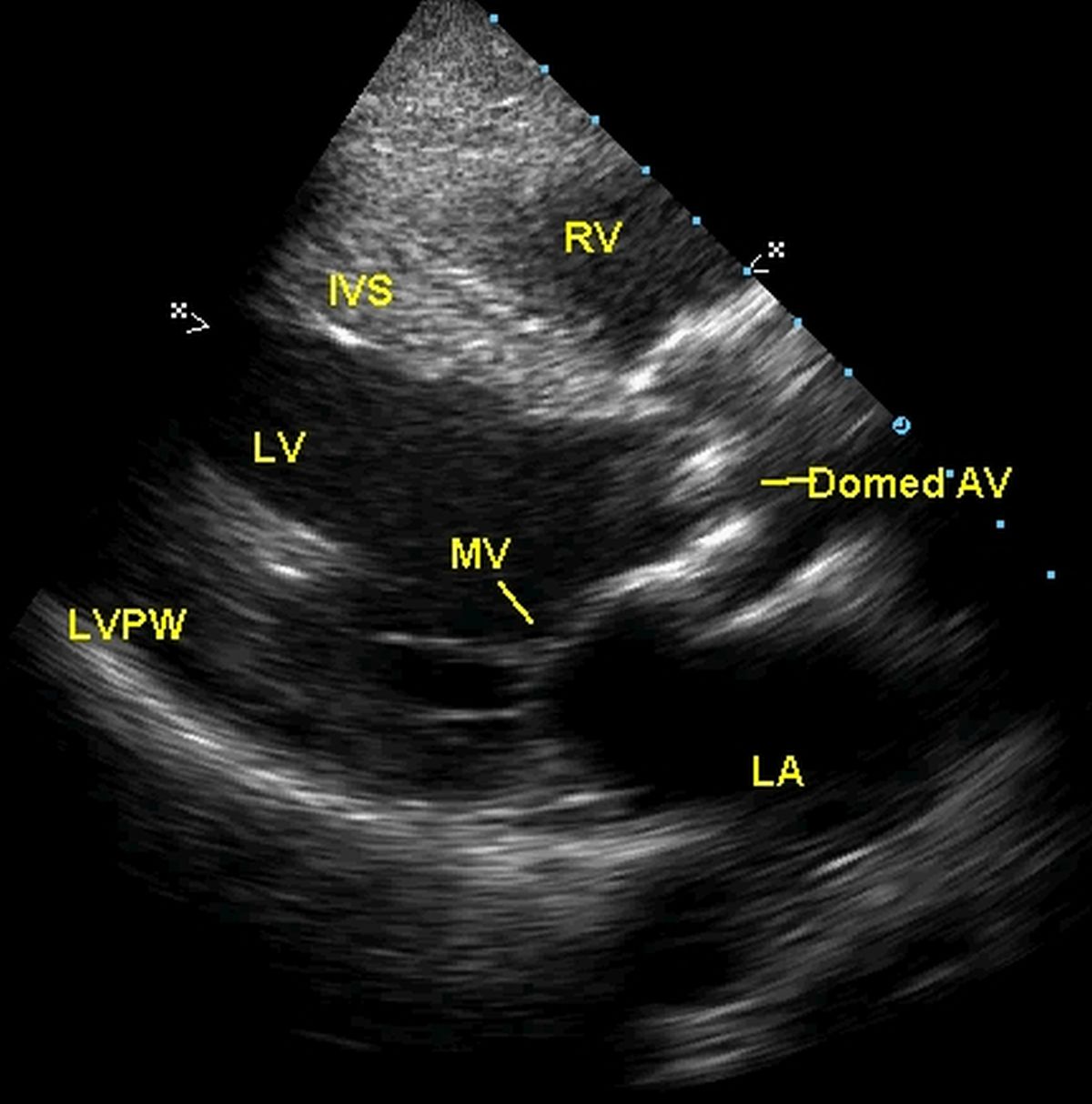 Echocardiogram from the left parasternal region showing thickened and doming aortic valve in severe aortic stenosis 