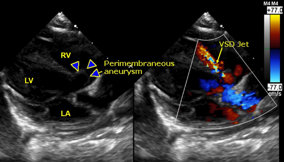 Perimembranous VSD with perimembranous aneurysm