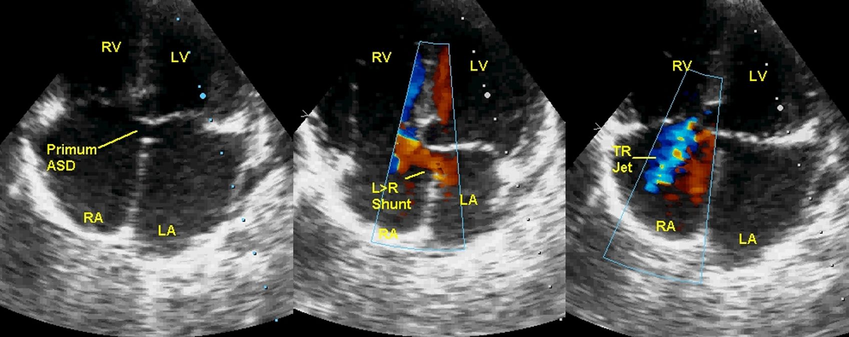 Echocardiogram from the apical four chamber view