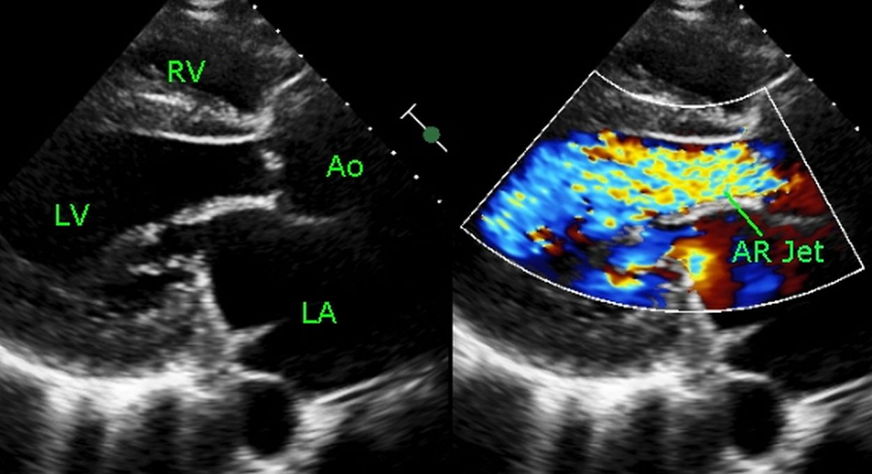 Echocardiogram from the parasternal region showing the high velocity mosaic colored aortic regurgitation jet from aortic valve to the left ventricle