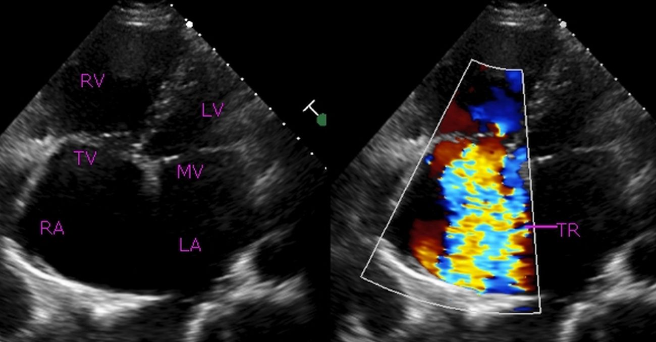 Echocardiogram in severe tricuspid taken in the apical four chamber view