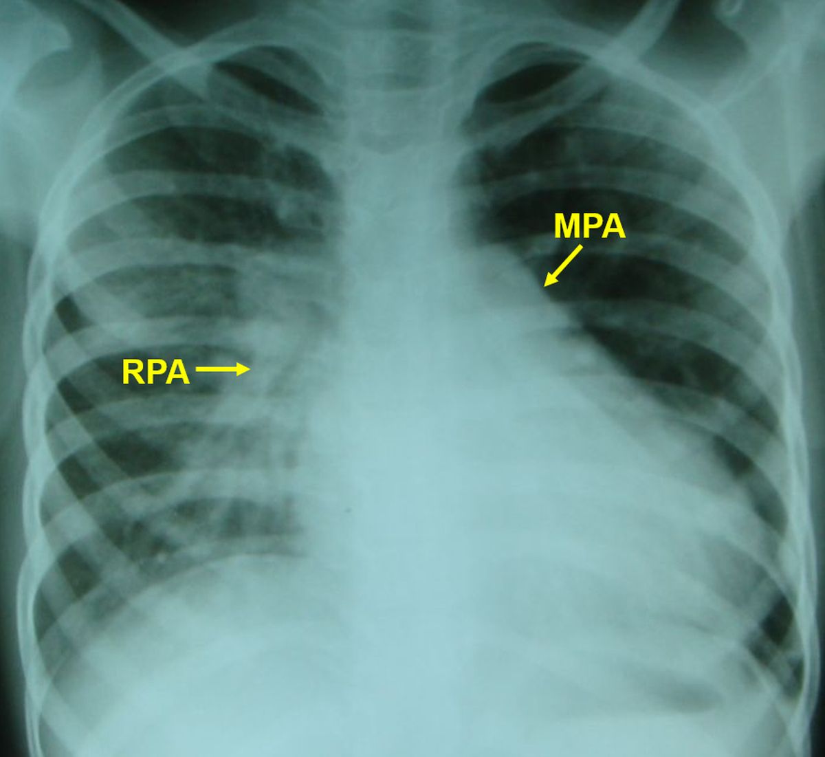 X-Ray chest PA View of a child with ventricular septal defect and left to right shunt and hyperdynamic pulmonary hypertension
