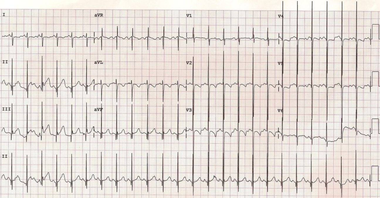 Ventricular Septal Defect Ecg