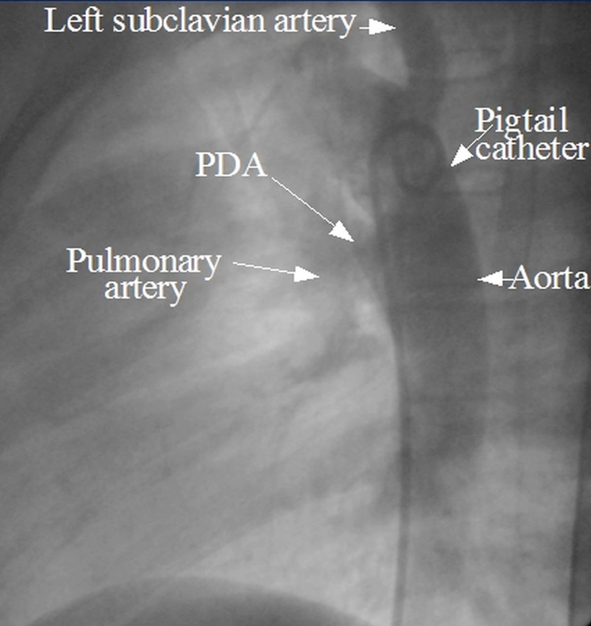 Patent ductus arteriosus - angio